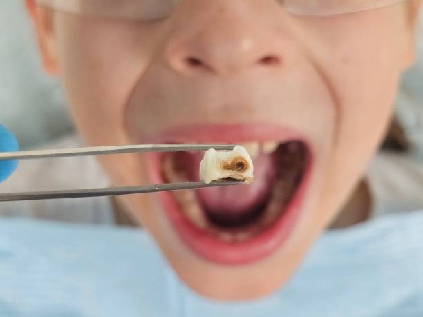 Best Emergency Tooth Extraction in Kemp Mill, MD